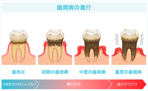 歯周病の進行